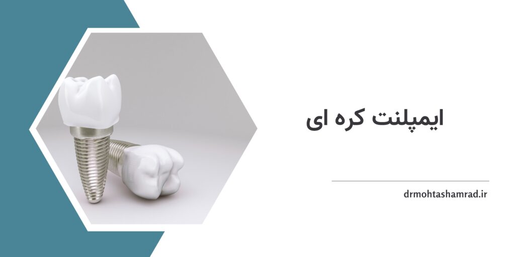 ایمپلنت کره ای