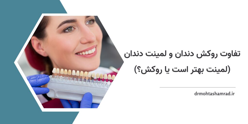 تفاوت روکش دندان و لمینت